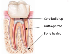 How does endodontic treatment save the tooth?