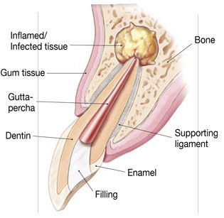 Apicoectomy