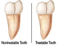 Cracked Teeth - Cracked Tooth