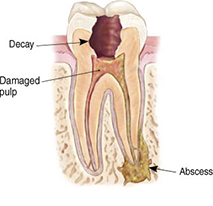 Endodontic Procedure - Step 1