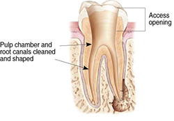 Endodontic Procedure - Step 2
