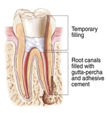 Endodontic Procedure - Step 3