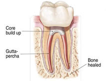 Endodontic Procedure - Step 4