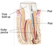 Endodontic Procedure - Step 4b