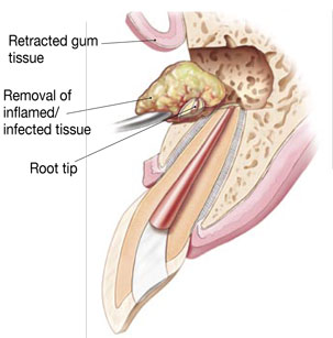 What is an Apicoectomy - 01