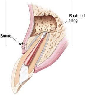 What is an Apicoectomy - 02