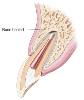 What is an Apicoectomy - 03