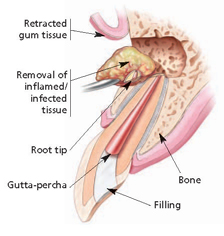 What is endodontic surgery?