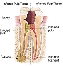 Why would I need an endodontic procedure?