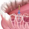 Endodontist Root Canal