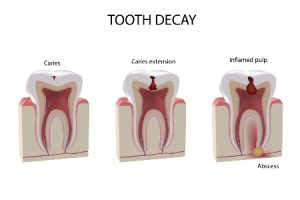 Tooth Decay Stages