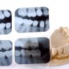 Full Mouth Dental X-rays