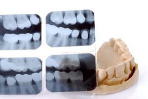 Full Mouth Dental X-rays